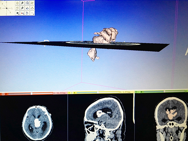 双色球神经外科完成东北地区首例3D Slicer手机软件设备导航下内镜辅助脑血肿 ...